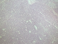 Hepatocellular carcinoma (histology)