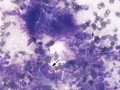 Sarcoma (spleen)