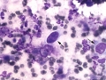 Sarcoma (spleen)