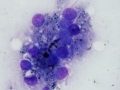 Cholestasis