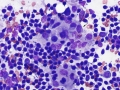 Sinus histiocytosis