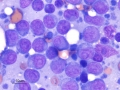 Lymphoma (marginal zone B cell)