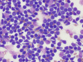 Lymphoma (indolent T zone)