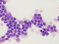 Lymphoma (indolent T zone)