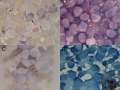 Acute myeloid leukemia