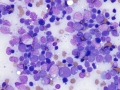 Acute myeloid leukemia