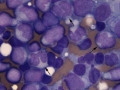 Acute myeloid leukemia