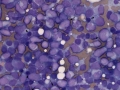 Acute myeloid leukemia