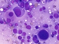 Acute megakaryoblastic leukemia