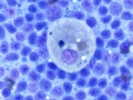 Hemosiderophage (DQ)