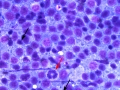 Lymphoma (not typed, DQ)