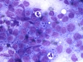 Lymphoma (B cell, aggressive, DQ)