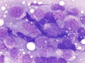 Lymphoma of granular lymphocytes
