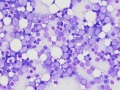 Acute myeloid leukemia