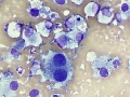 Histiocytic sarcoma