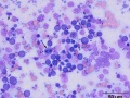 Indolent T zone & B cell lymphoma