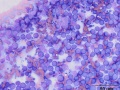 B cell lymphoma