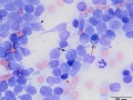 Lymphoma (indolent T zone)