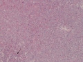 Acute myeloid leukemia (H&E)