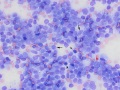Lymphoma (indolent T zone)
