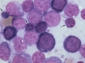 Acute myeloid leukemia