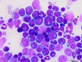 Acute myeloid leukemia