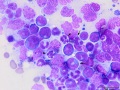Acute myeloid leukemia