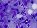 Acute myeloid leukemia
