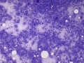 Acute myeloid leukemia
