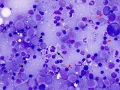 Acute myeloid leukemia