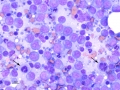 Lymphoma (marginal zone, B cell)
