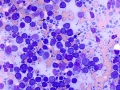 Lymphoma (B cell, aggressive)