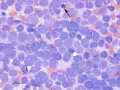 Nephroblastoma (suspect)