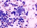 Multinucleated macrophage