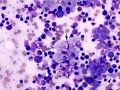 Necrosis & granulomatous inflammation