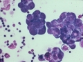 Nasal carcinoma