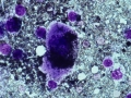 Melanoma