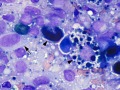 Melanoma