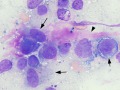 Melanoma with matrix