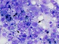 Melanoma