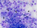 Melanoma