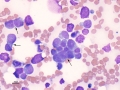 Nephroblastoma (suspect)