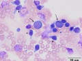 Indolent T zone & B cell lymphoma