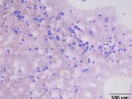 Indolent T zone & B cell lymphoma