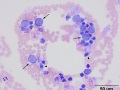 Indolent T zone & B cell lymphoma