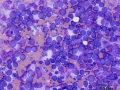 B cell lymphoma