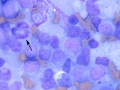 Lymphoma (suspect T cell)