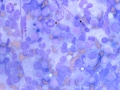Lymphoma (suspect T cell)