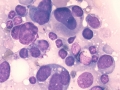 Acute megakaryoblastic leukemia