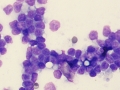 Lymphoma in remission